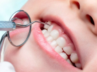 Ультразвуковое удаление на зубных отложений