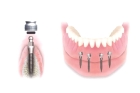 Установка зубных имплантов нижних зубов