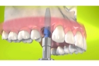 Установка зубных имплантов верхних зубов