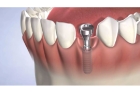 Установка зубных имплантов жевательных зубов