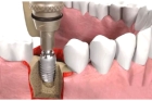 Установка имплантов зубов под ключ