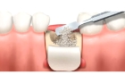 Наращивание костной ткани при имплантации зубов