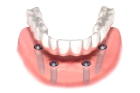 Полная имплантация зубов нижней челюсти