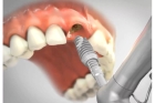 Имплантация передних зубов 