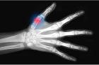 Рентгенография пальца  