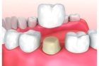 Коронка зуба металлокерамическая 