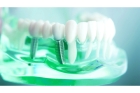 Импланты на удаленный зуб
