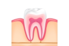 Лечение хронического пульпита зуба