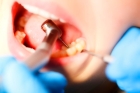 Профессиональная чистка зуба перед лечением
