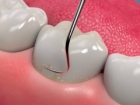 Снятие над и поддесневых отложений с одного зуба