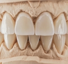 Керамическая коронка на зуб (E-max)