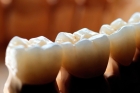 Керамическая коронка на зуб (E-max) на имплант