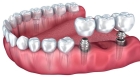 Несъемное протезирование зубов на импланте
