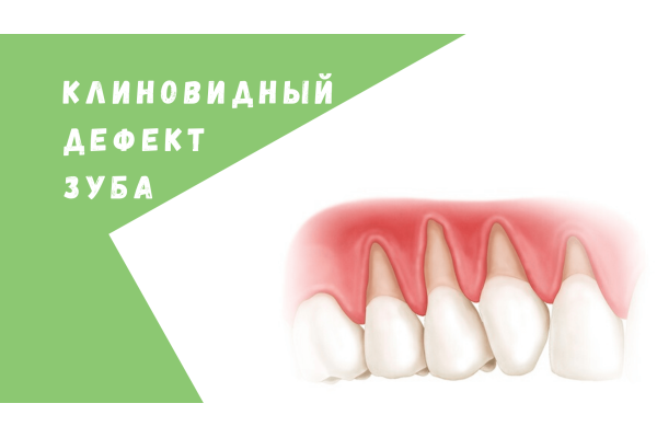 Лечение дефекта зуба