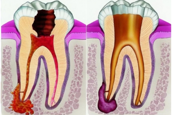 Лечение периодонтита четырехканального зуба