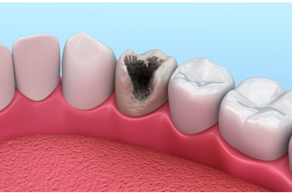 Восстановление кариозного зуба