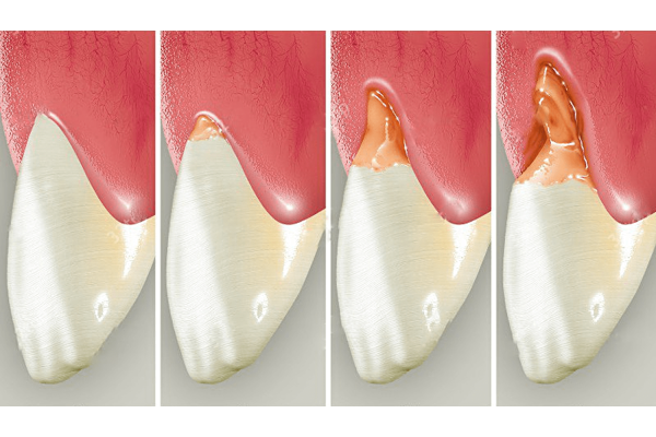 Восстановление дефектов зуба