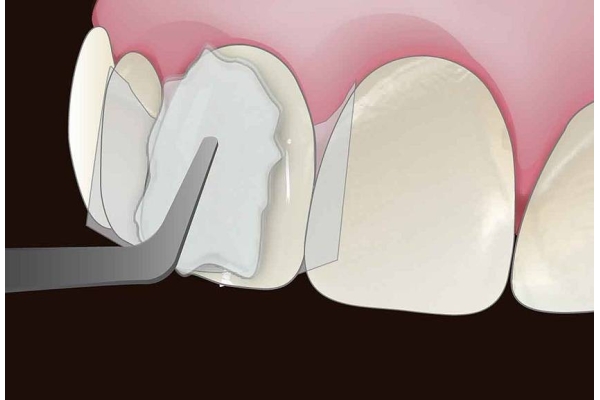 Восстановление передних зубов