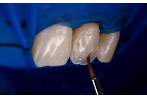 Художественная реставрация зуба с использованием микроскопа