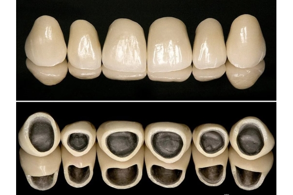 Металлокерамическая зубная коронка