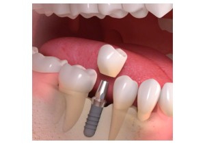 Удаление зубного импланта сложное