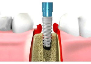 Удаление зубного импланта простое