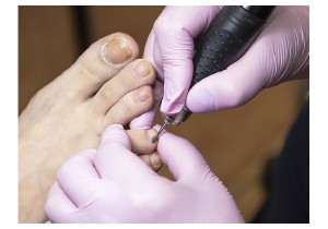 Лечение трещин ногтя