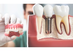 Установка корейского импланта зуба
