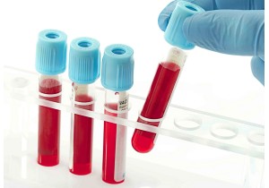 Анализ крови Иммуноглобулин А