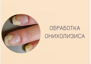 Обработка ногтя с онихолизисом