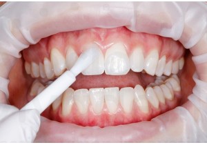 Покрытие зуба (фторирование) 1 зуб