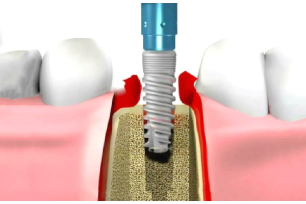 Удаление зубного импланта простое
