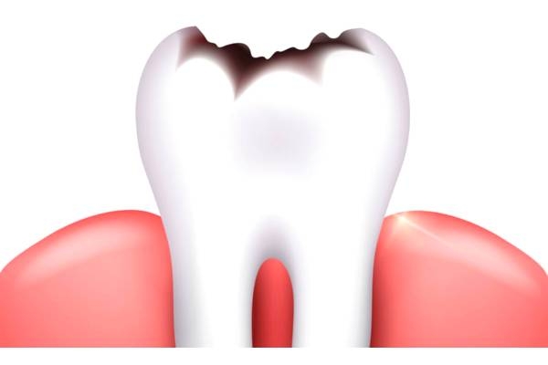 Современное лечение кариеса зубов