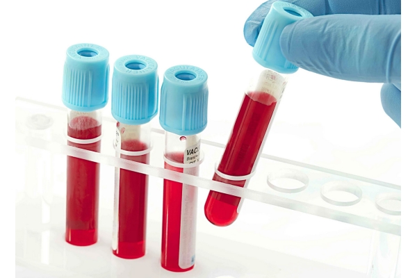 Общий анализ крови без лейкоцитарной формулы (с СОЭ)