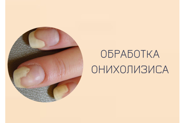 Обработка ногтя с онихолизисом
