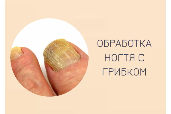 Обработка ногтя с грибком