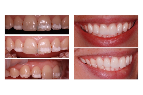 Частичная реставрация зуба 