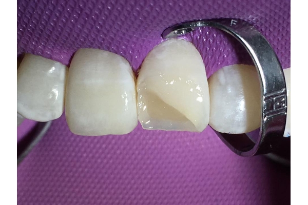 Реставрация скола зуба 