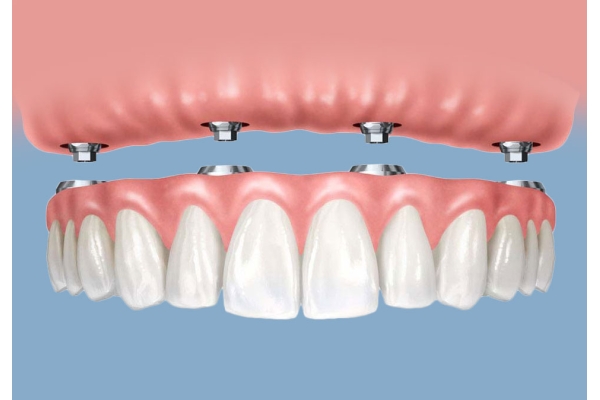 Протезирование зубов на 4 имплантах    