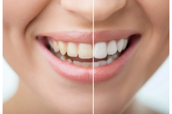 Отбеливание зубов у стоматолога 