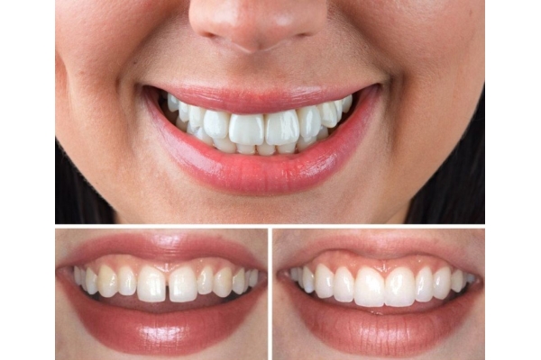 Восстановление зуба