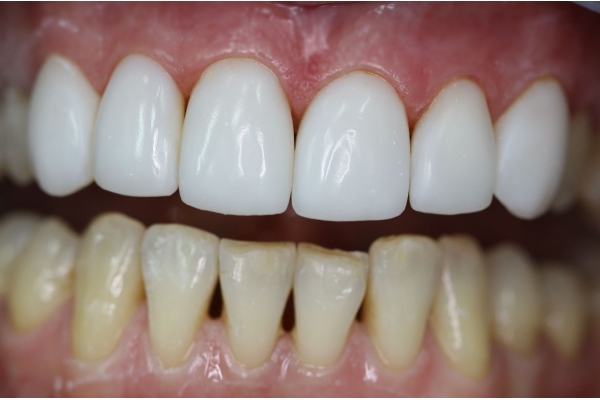 Реставрация эмали зуба