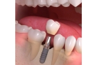 Удаление зубного импланта сложное
