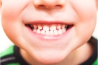 Исправление прикуса зубов у детей