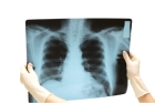 Рентгенография грудной клетки   