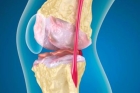 Лечение артроза коленного сустава 