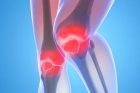 Лечение артрита коленного сустава 