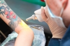 Удаление татуировок 