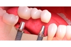 Имплантат зуба под ключ