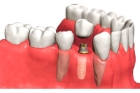 Имплантация зубов недорого